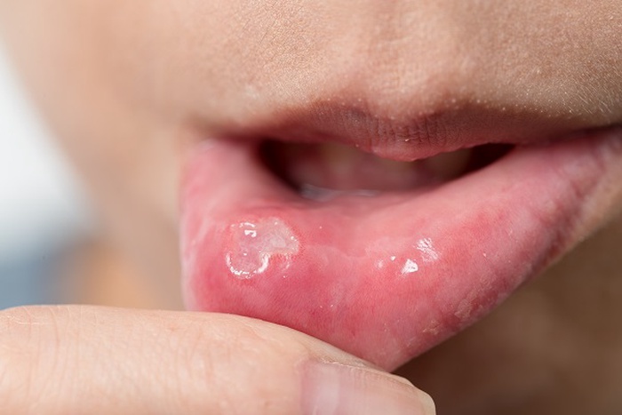 herpes inside lip