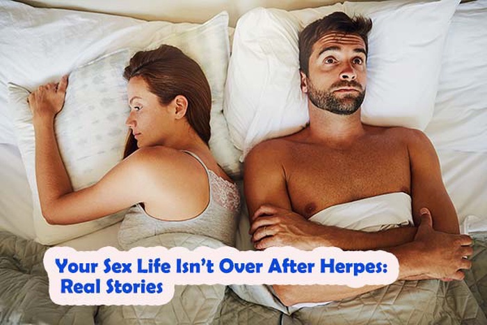 Is sex over after herpes?