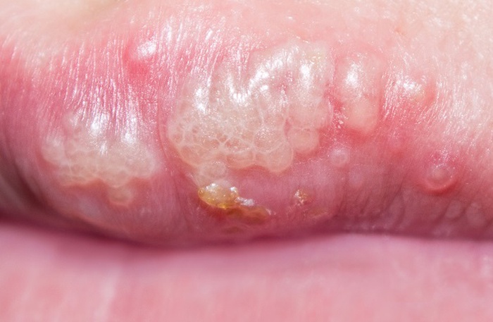 herpes on lip images