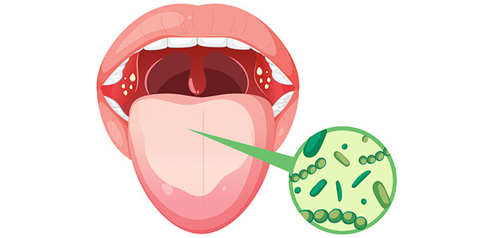 Mouth Ulcer and HIV