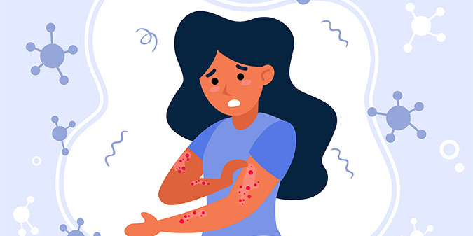 Herpes and Shingles