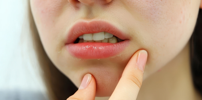 New Cold Sore Discovery Brings Hope for Herpes Prevention