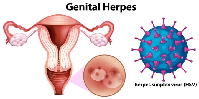 genital herpes virus